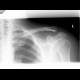 Diastasis in acromioclavicular joint after removal of osteosythetic material: X-ray - Plain radiograph